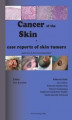 Okładka książki: Cancer of the Skin - case reports of skin tumors